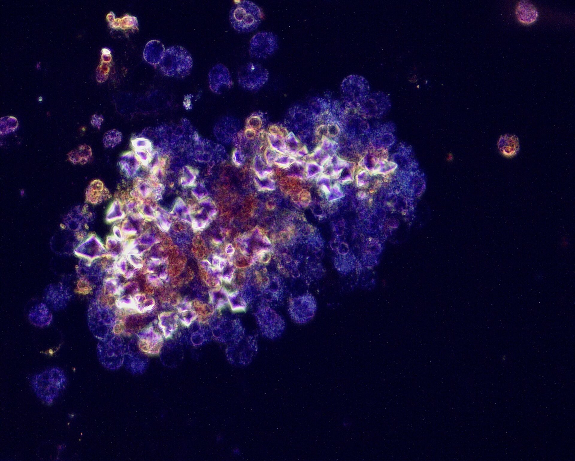 Dark field image of cluster of calcium oxalate dihydrate crystals surrounding leukocytes