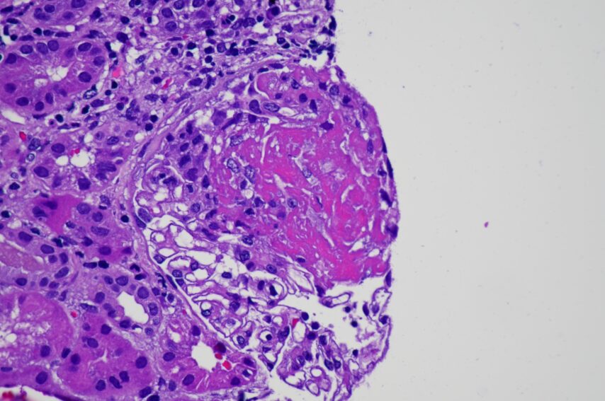 Fibrinoid necrosis in a patient with ANCA-associated glomerulonephritis