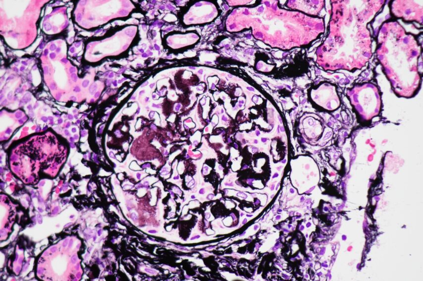 Eyelash sign in glomerular amyloidosis