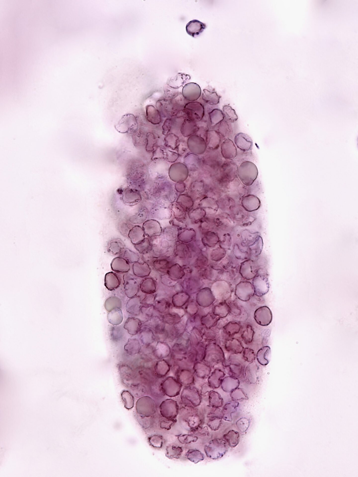 Red blood cell cast – brightfield with Sternheimer-Malbin stain