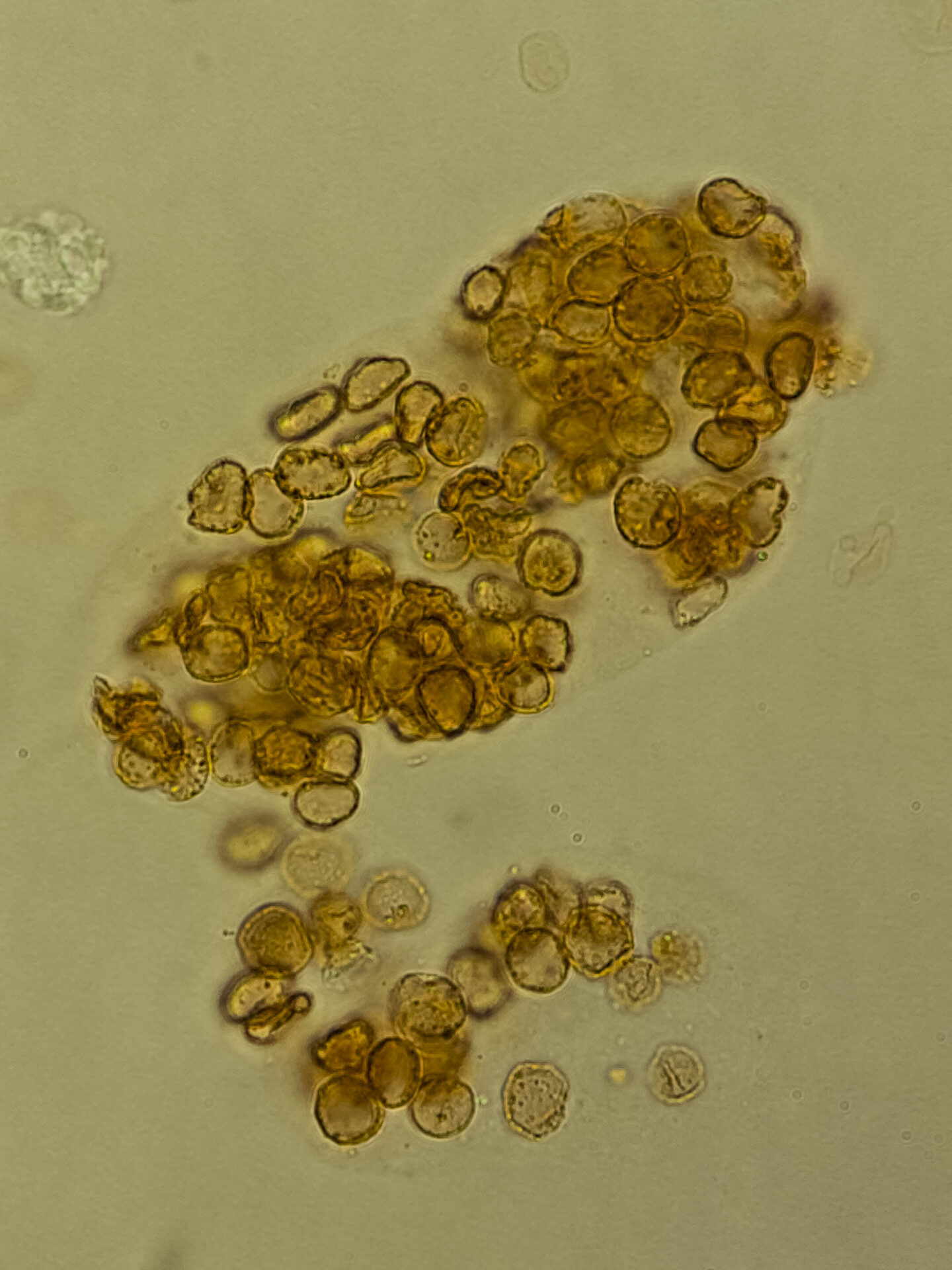 Red blood cell cast indicating glomerulonephritis in a patient with AntiNeutrophil Cystoplasmic Antibody (ANCA) associated vasculitis